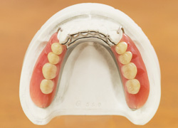 入れ歯の製作の流れ