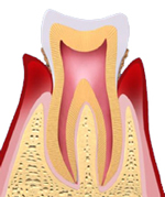 歯周病